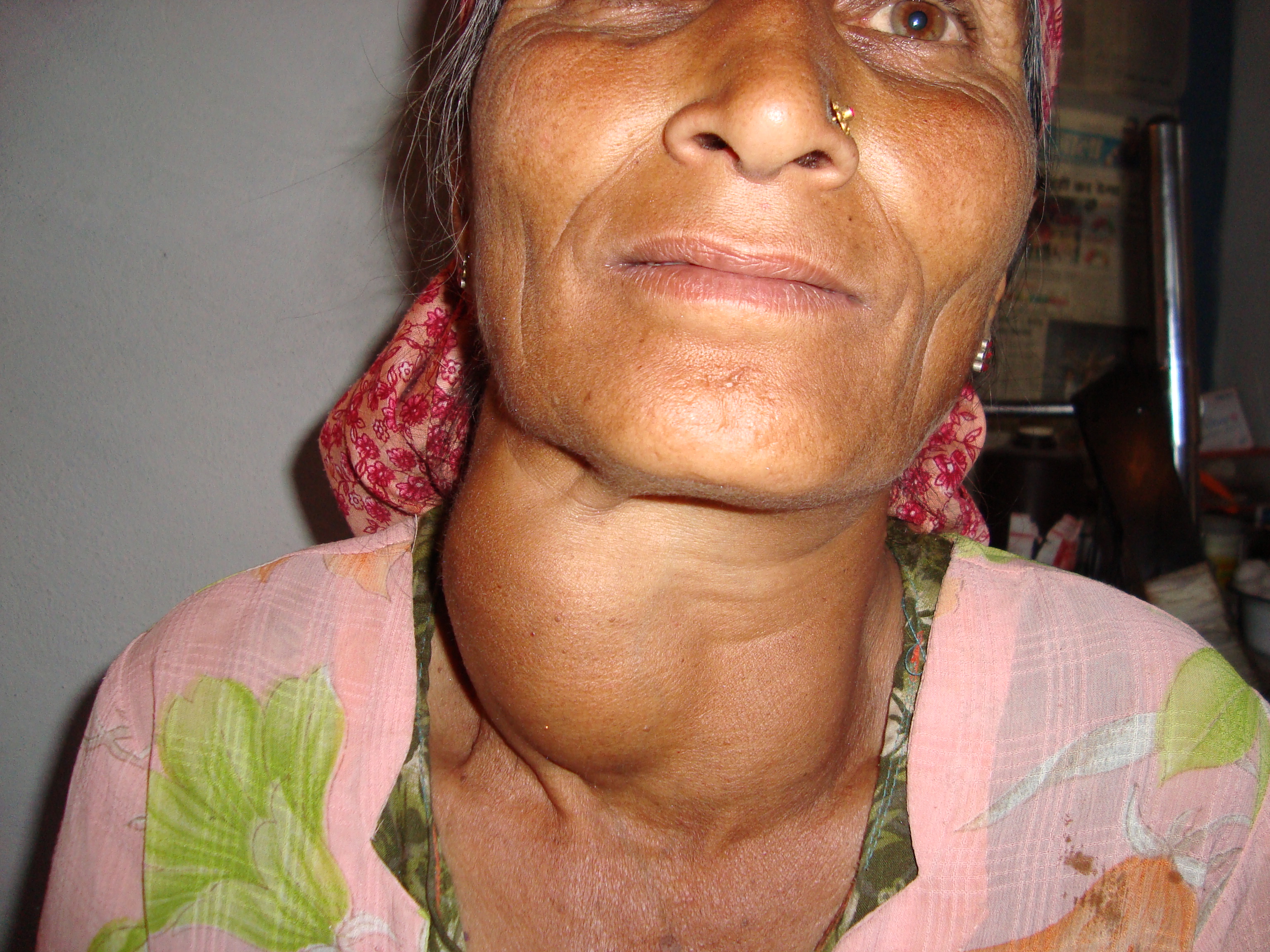 A woman with a visibly enlarged thyroid, or goiter